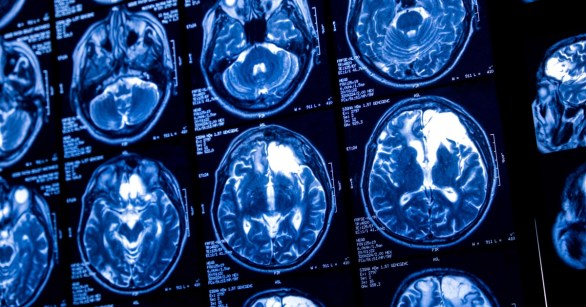 AA1NKLHt Pengobatan Stimulasi Otak Eksperimental Mengarahkan Pasien Depresi Kronis Melaporkan Merasa Bahagia yang Luar Biasa