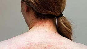 4 things you need to know about 'bacne' or back acne