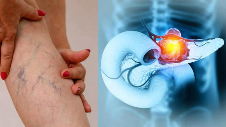 Four Leg Symptoms May Be the First Warning Signs of a Deadly Cancer Affecting Over a Million Each Year
