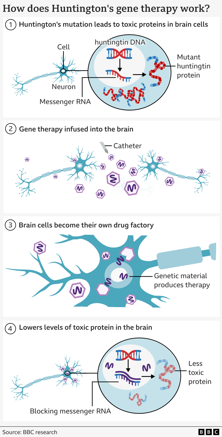Huntington's disease successfully treated for first time