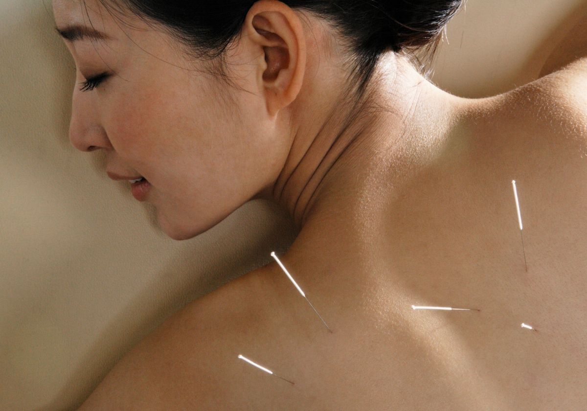 8 Manfaat Akupuntur untuk Kesehatan, Termasuk Kendalikan Tekanan Darah