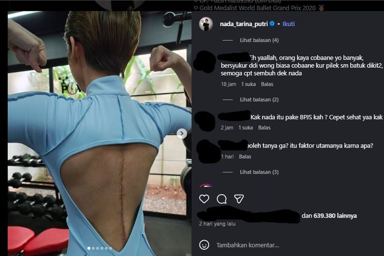 Apakah Operasi Skoliosis Ditanggung JKN? Ini Jawaban BPJS Kesehatan