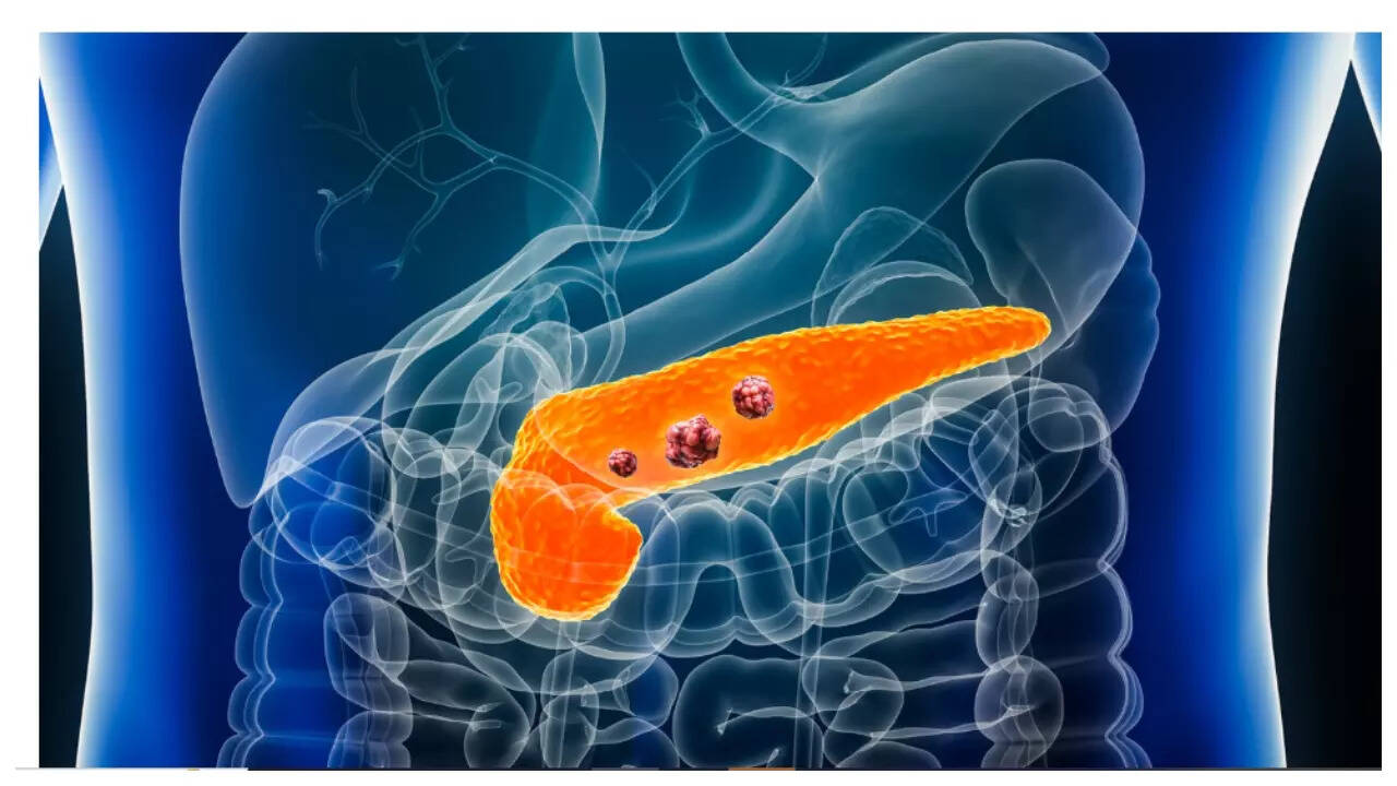 Pancreatic cancer breakthrough experts tie deadly disease to this key