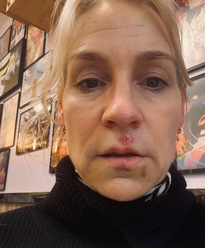 Person with an injured nose and lip, wearing a turtleneck. Multiple framed pictures are visible on the wall behind