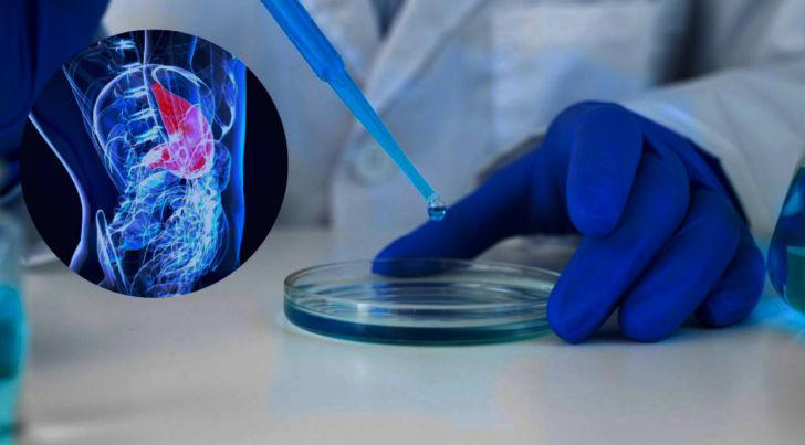 Cáncer de páncreas: el síntoma que todos ignoran y es clave para detectarlo a tiempo