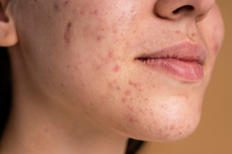 Jerawat Batu Lebih Berbahaya, Ini Penyebab dan Cara Mengatasinya