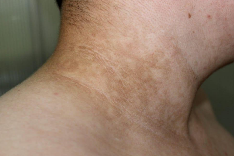 Bercak Gelap di Kulit? Ini Penyebab dan Cara Mengatasinya