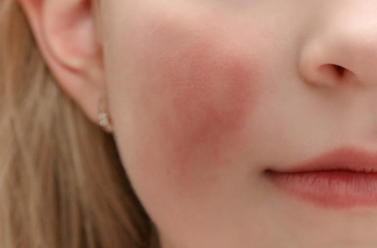 What to know about fifth disease (“slapped cheek” disease)