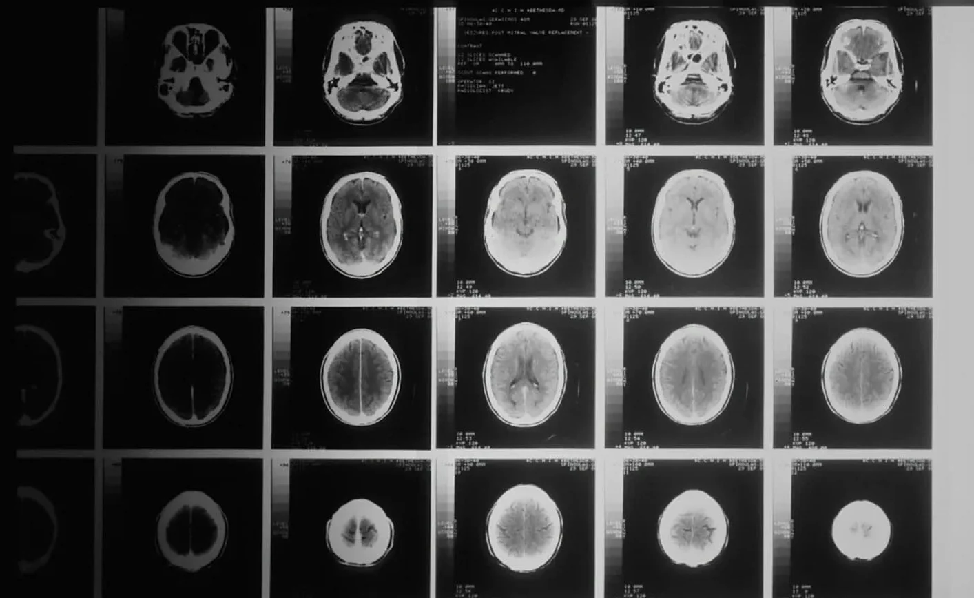 Menino de 13 anos é o primeiro no mundo a ser curado de câncer cerebral raro: "Desafiou todas as probabilidades"