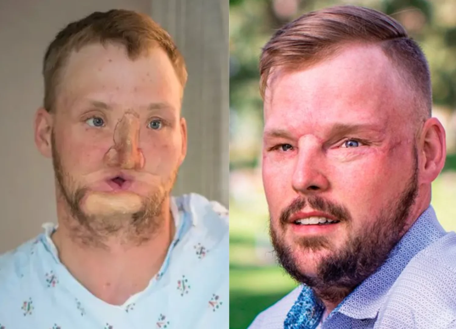 Homem que atirou no próprio rosto passa por transplante e volta a sorrir
