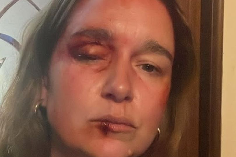 Vicki Fowler actress Alice Haig revealed how her character's injuries were constructed