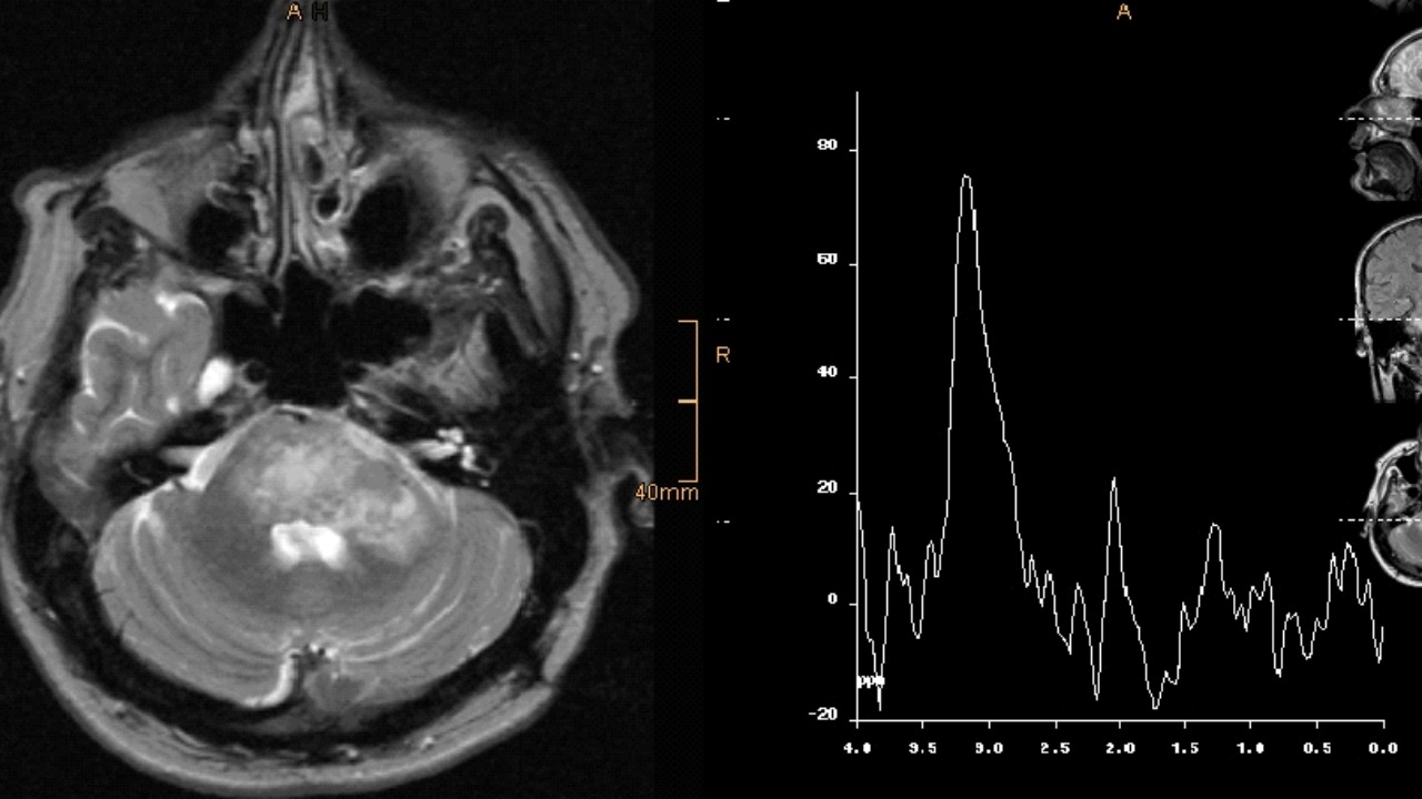 Scientists Discover A Possible Off Switch For Chronic Pain