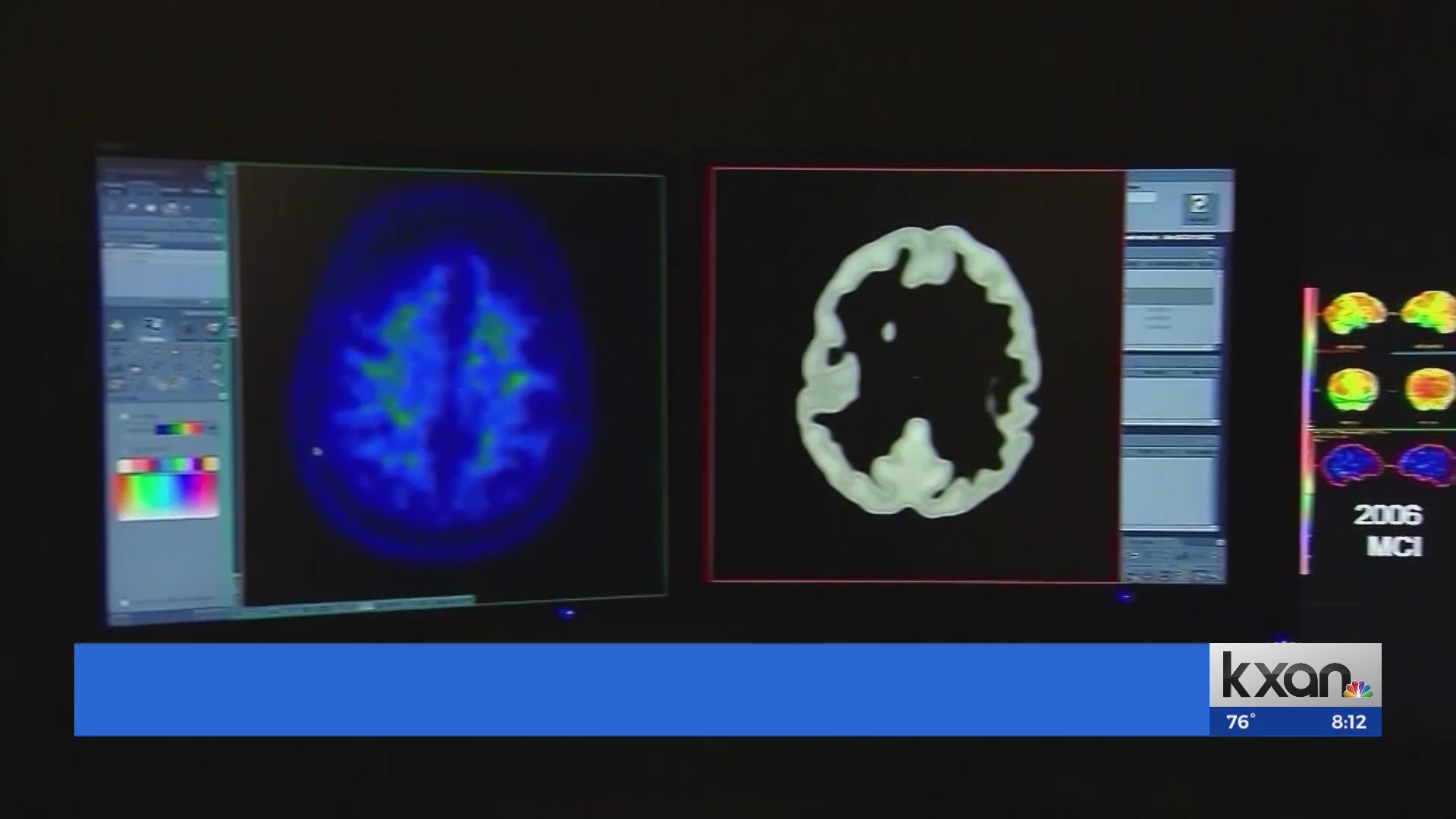 How Proposition 14 could make Texas a national leader in Alzheimer's ...