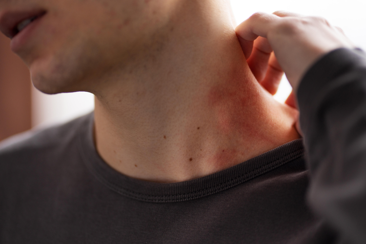 Hanya Bayi? 4 Jenis Biang Keringat yang Menyerang Dewasa, Cari Tahu Penyebab dan Cara Mengatasinya