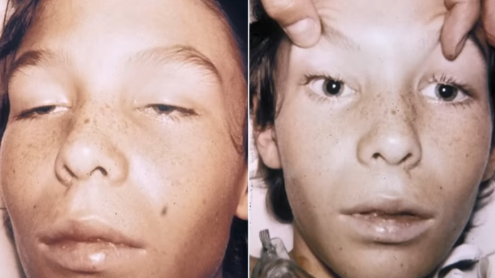 10,000 Times Deadlier Than Sarin - Botulinum