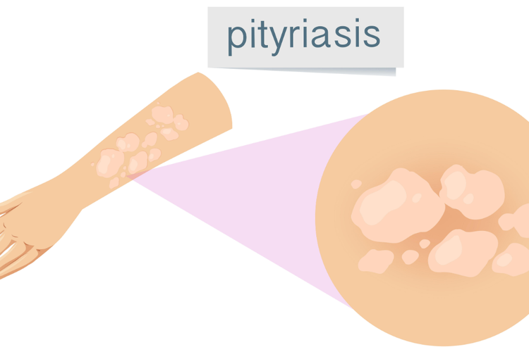 Benarkah Mandi Saat Berkeringat Menyebabkan Panu? Ini Penjelasan Ilmiahnya