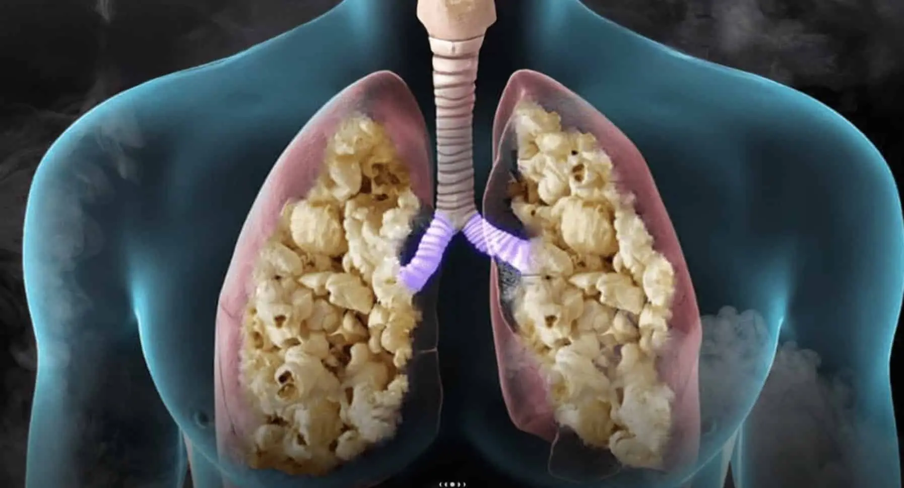 Pulmão de Pipoca: Veja a doença pulmonar grave que afeta jovens no Brasil