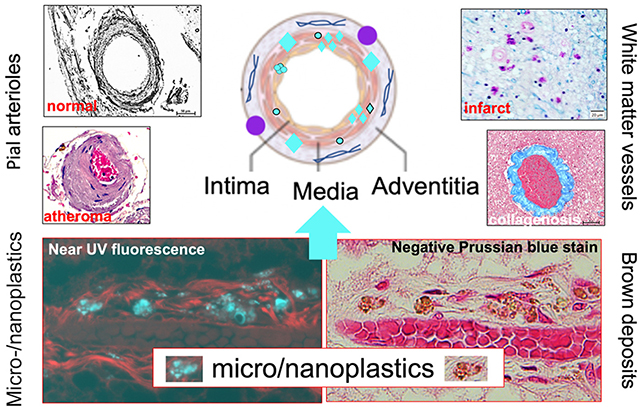 AA1OQu2D Microplastics Linked to Vascular Dementia, Study Reveals