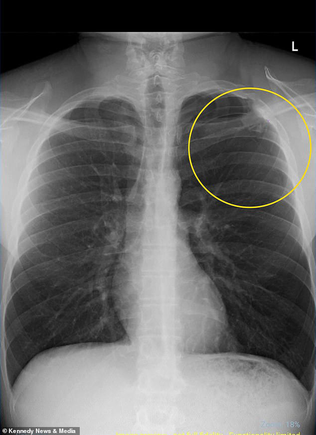 Man who vaped 'every 10 seconds' suffers lung injury… 'never thought it'd  happen'