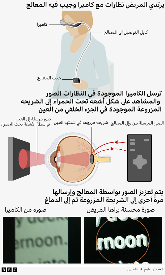 اختراق طبي مذهل يُغيّر حياة المكفوفين ويُساعدهم على القراءة مجدداً