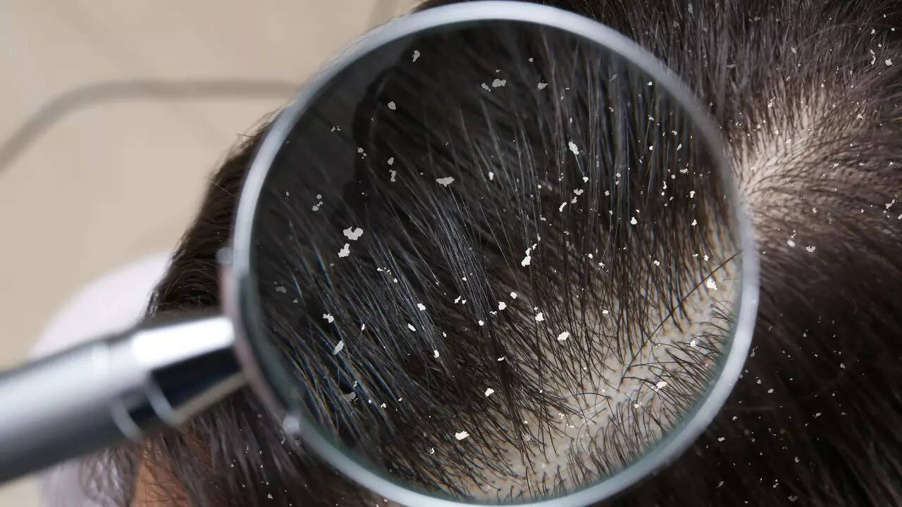 Treat your dandruff right: Identify your type for flake-free scalp