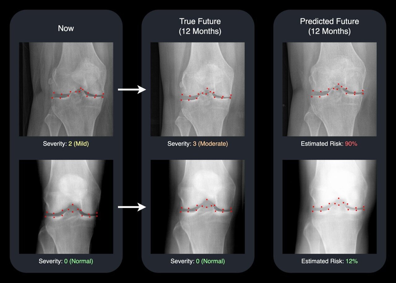 AI predicts future X-rays to help osteoarthritis patients and their ...