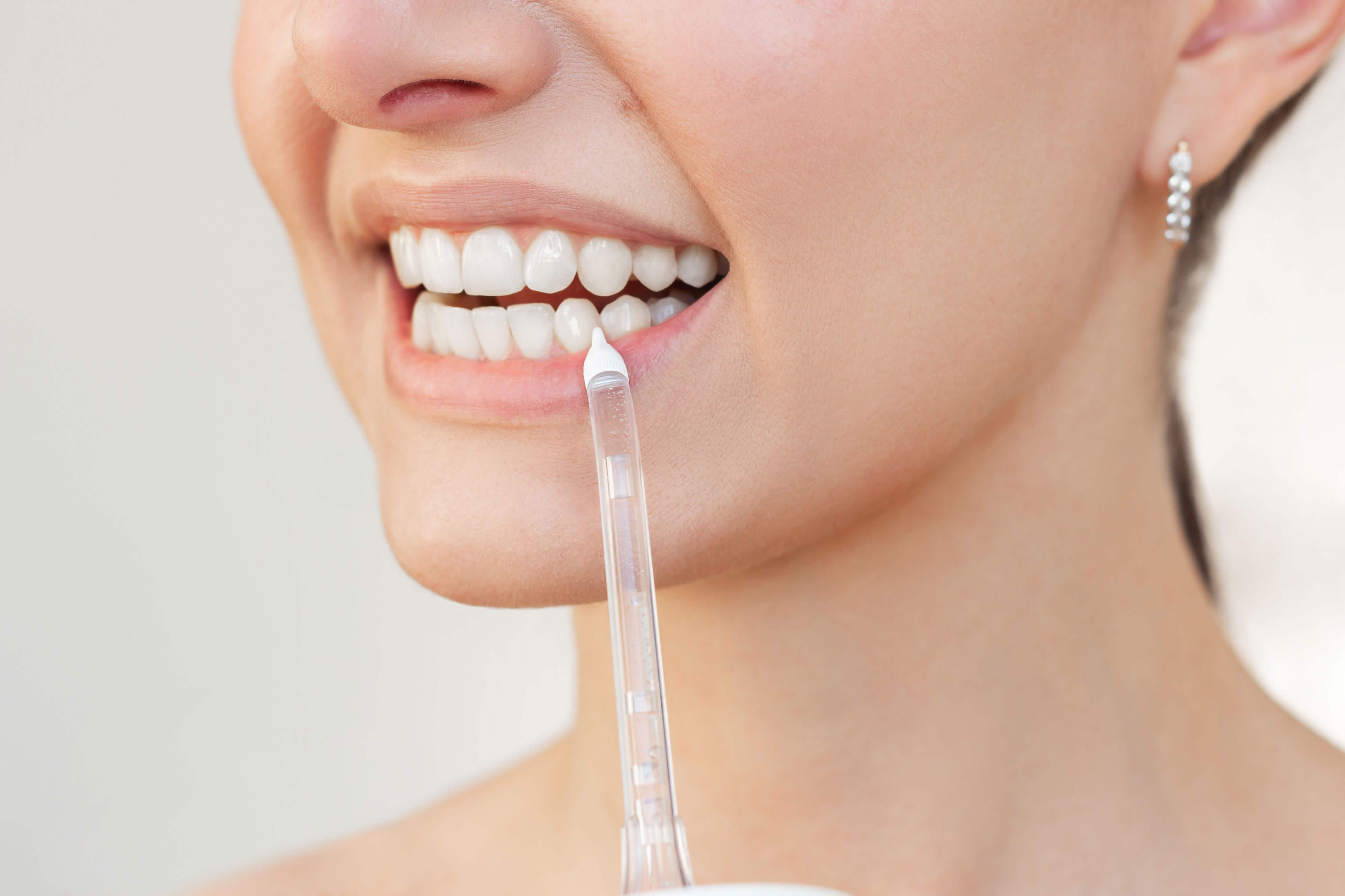 A person smiling while applying teeth whitening gel with a clear applicator, showing close-up of their teeth