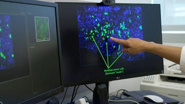 Scientists seek to wipe out breast cancer's 