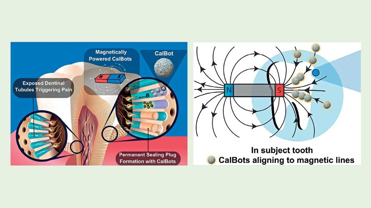 Tech Watch | Tooth sensitivity: Nanobots to the rescue