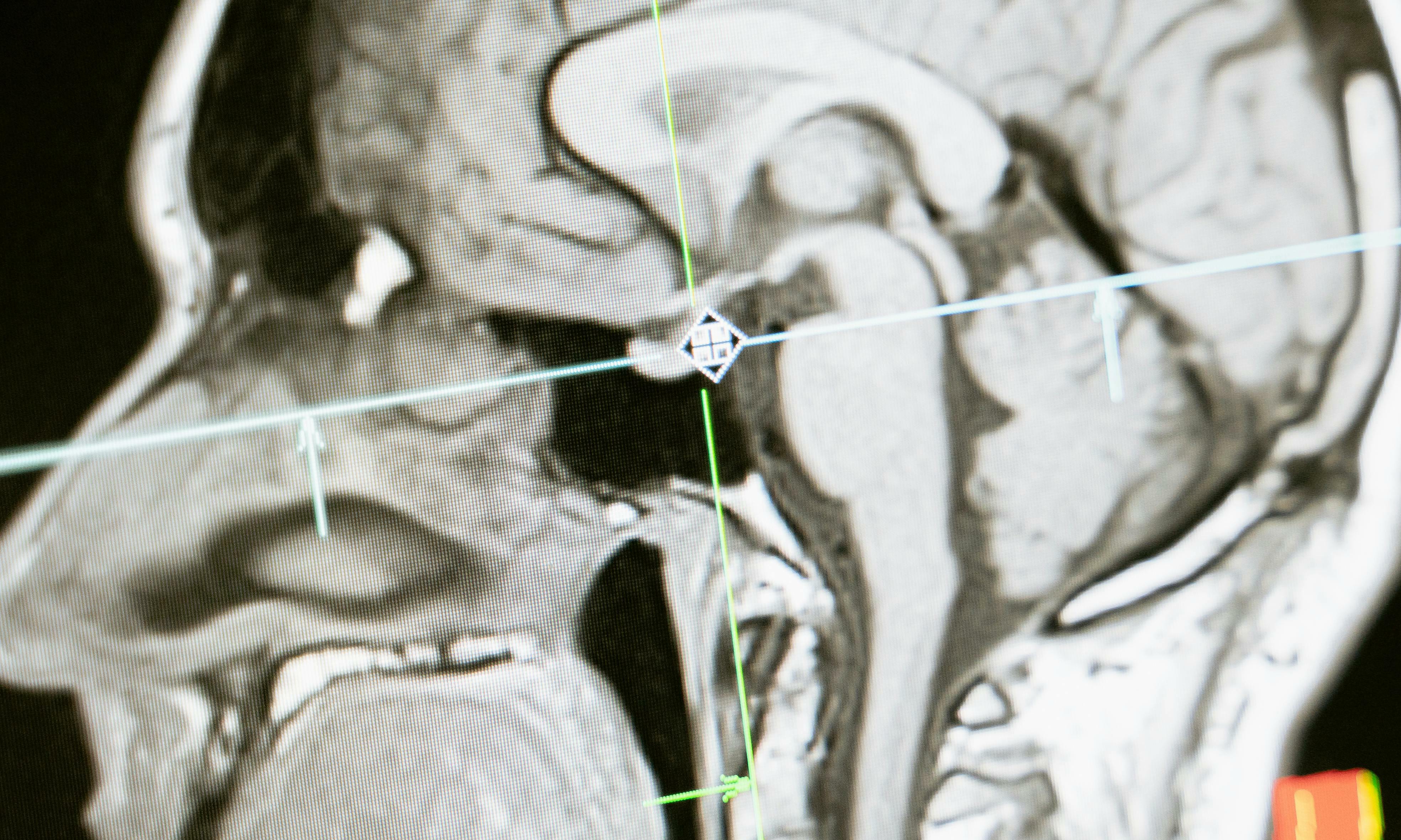 15-year-old suffers brain damage after vaping drug-laced e-cigarette