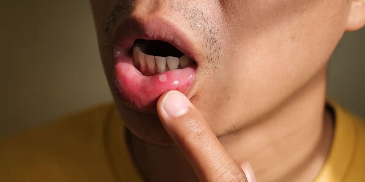 Tự ý ngừng thuốc chữa nhiệt miệng, người đàn ông mù một mắt