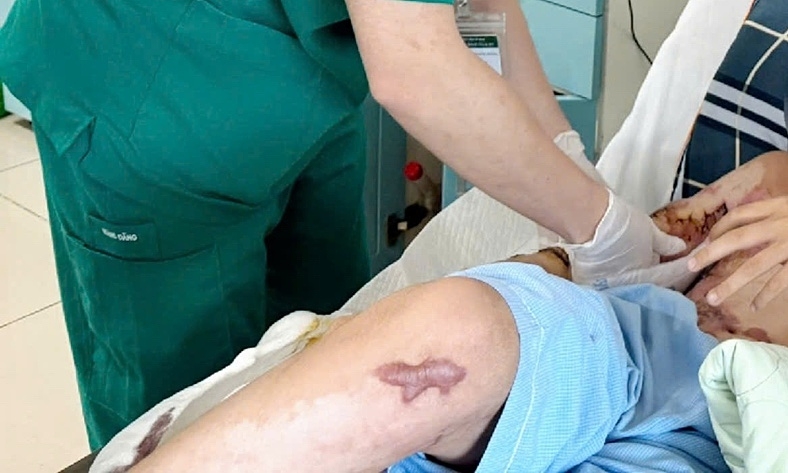 Bệnh nhân bỏng vật lộn với di chứng suốt phần đời còn lại