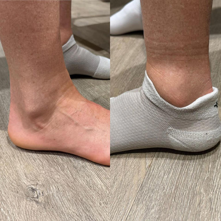 I Wore 1 Ankle Sock and 1 Compression Sock on a 15-hour Flight—and the ...