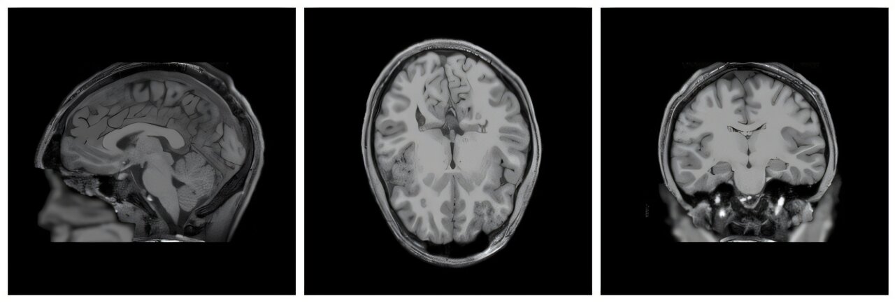 Massive database maps links between brain development and mental health