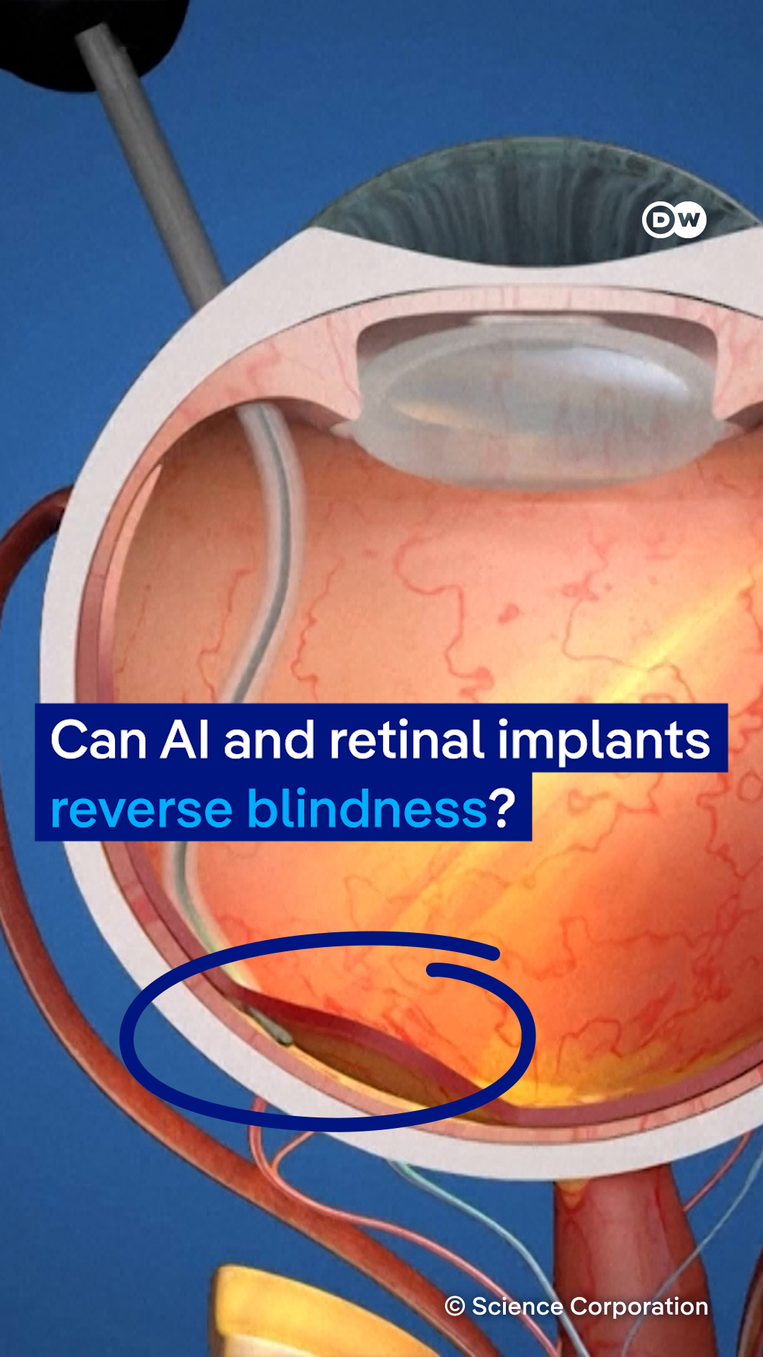 Can AI and retinal implants reverse blindness?