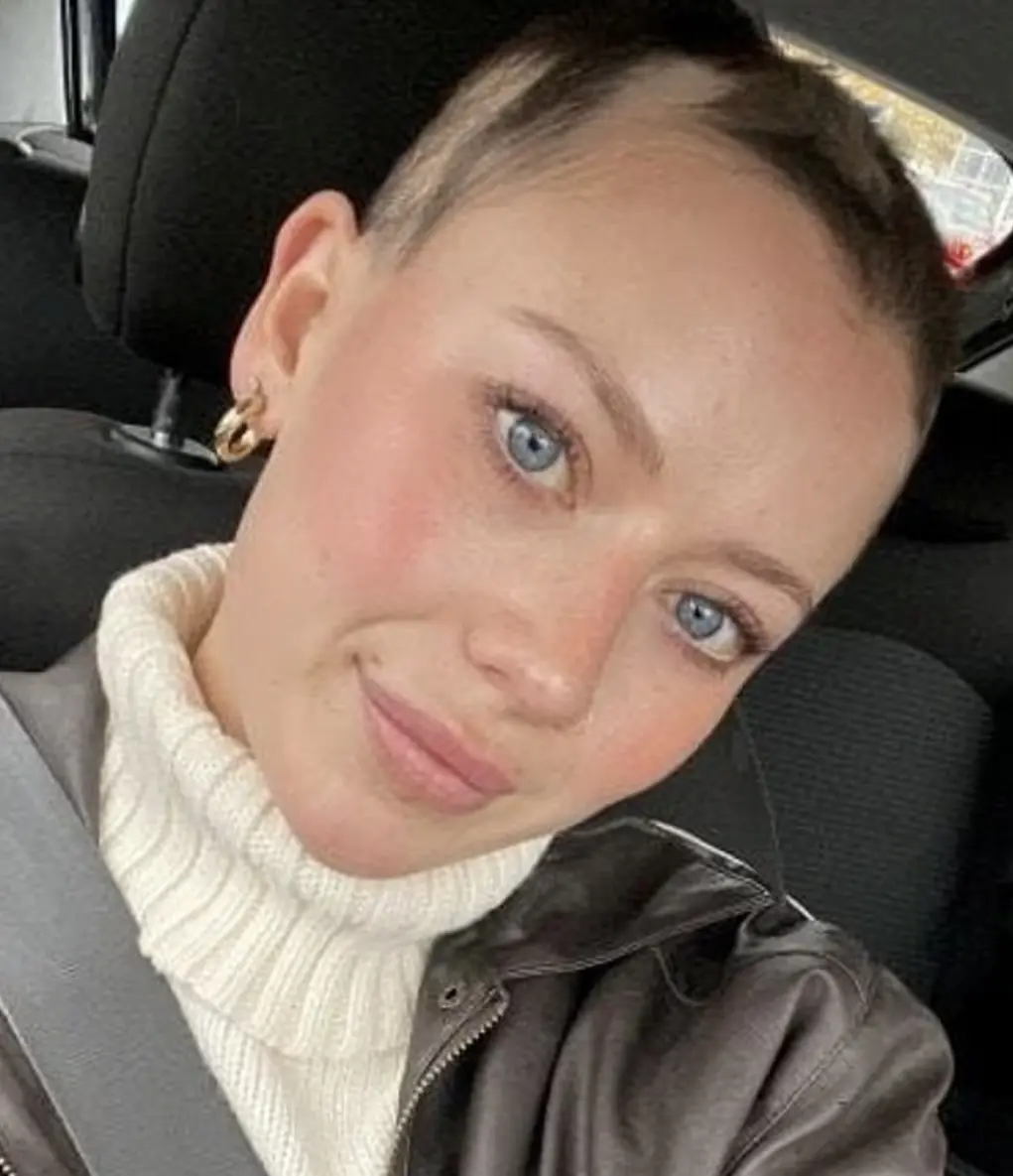 Jovem perde todo o cabelo após crise de estresse no trabalho