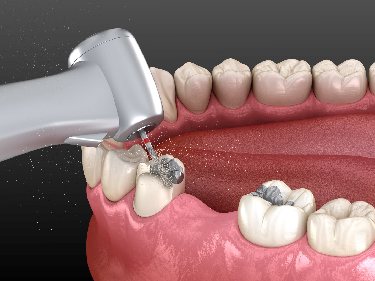 Nhiều nước kêu gọi cấm vật liệu trám răng chứa thủy ngân trước năm 2030