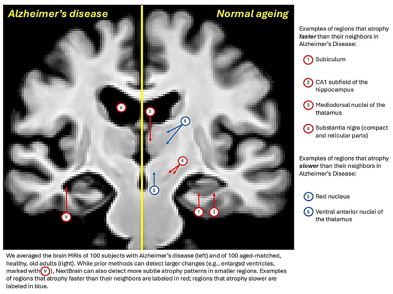 New brain atlas offers unprecedented detail in MRI scans