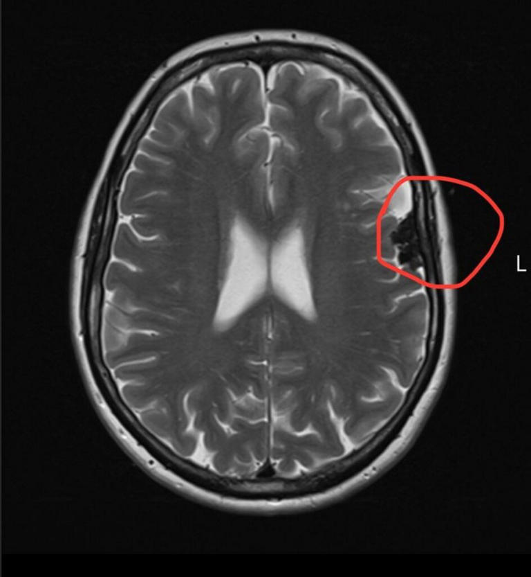 Woman’s ‘menopause brain fog’ was actually two brain tumours