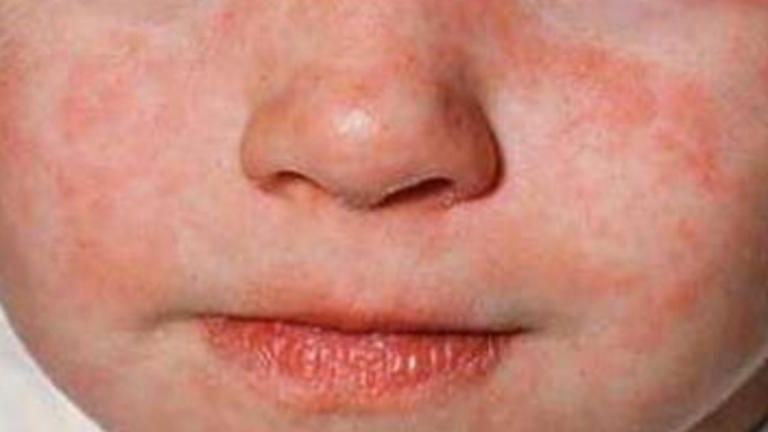 Warning as deadly disease outbreak grows