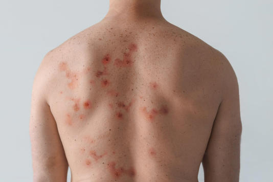 Common symptoms of mpox include a skin rash or pus-filled lesions which can last two to four weeks (Alamy/PA)