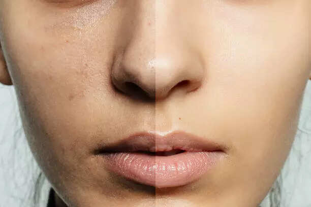 glutathione iv side effects liver 5 foods which are rich in Glutathione and brilliant for your skin