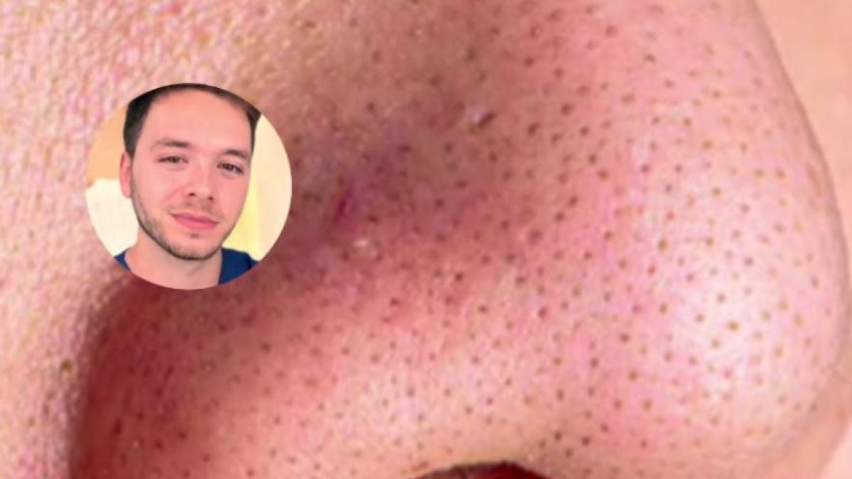 Francisco Vizcaíno, dermatólogo: ''Lo que tienes en la nariz no son ...