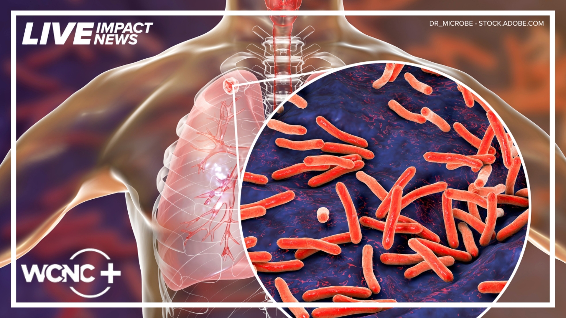 Novant Health provides updates after tuberculosis case reported in ...