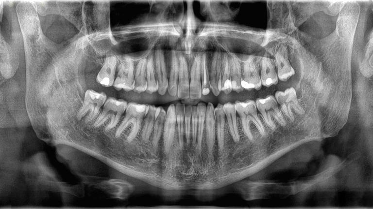 Why don't teeth count as bones?