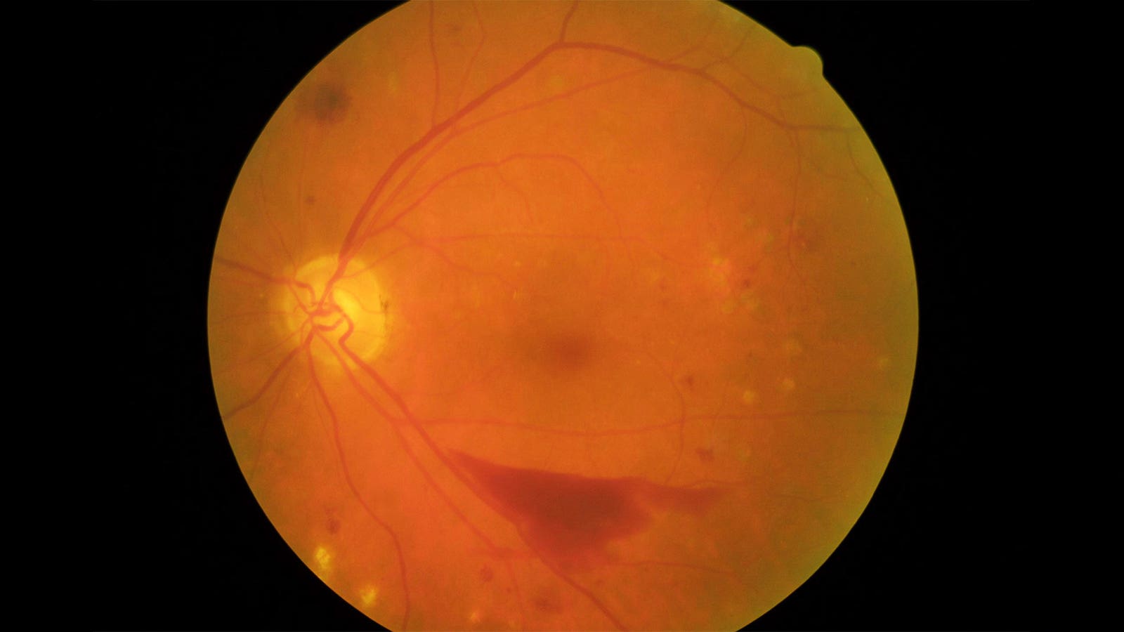 Recent Developments in Retinal Disease