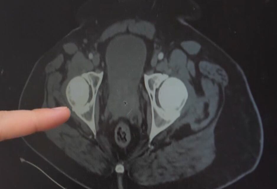 MU Health Care new laser surgery corrects enlarged prostates