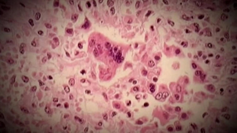 Possible measles exposure at Montreal's Trudeau airport, Sainte-Justine ...