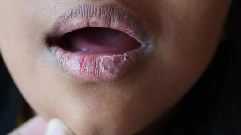 9 Signs of hormone imbalance on your face: Visible facial signs of ...