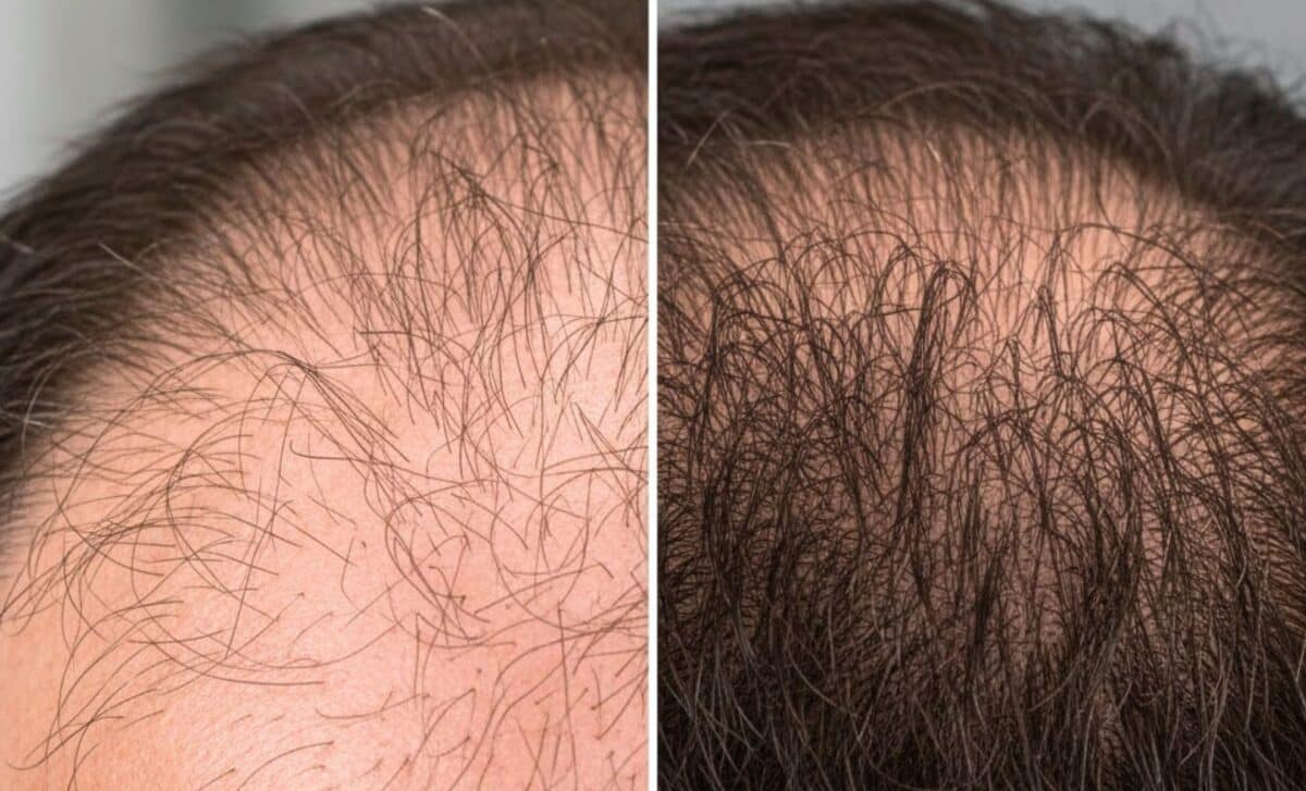New PlantBased Hair Serum Delivers Unbelievable Regrowth in Weeks